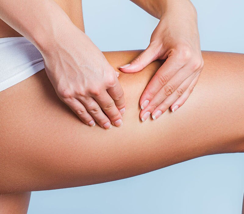 Cellulite Reduction Treatment in Delhi