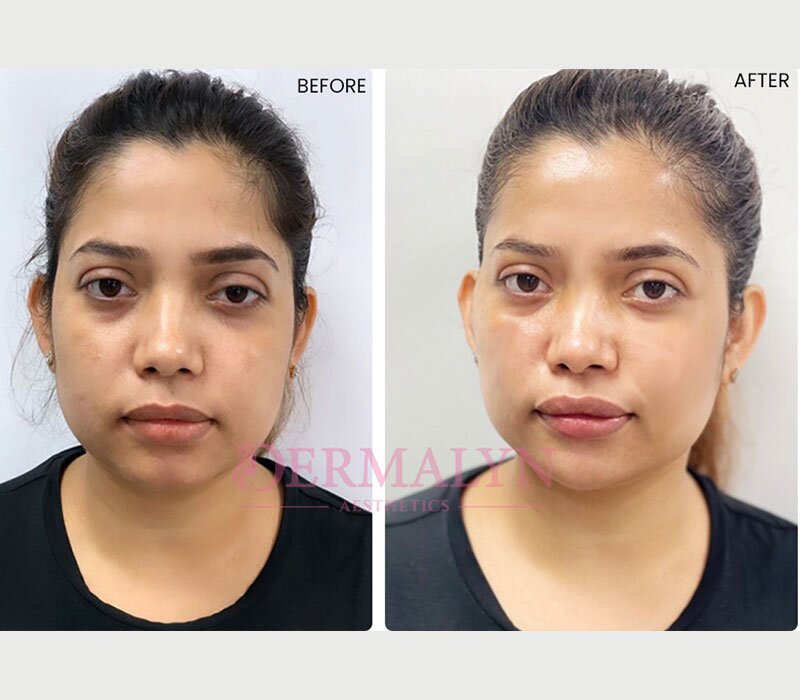non-surgical-facelift-img1-dermalyn2022