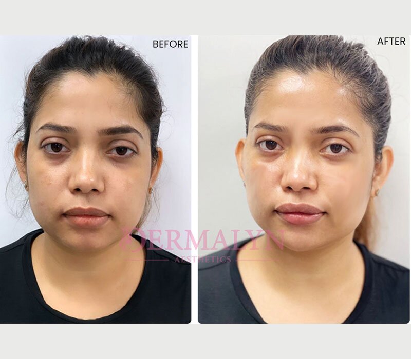 Minimally Invasive Face Lifting Options