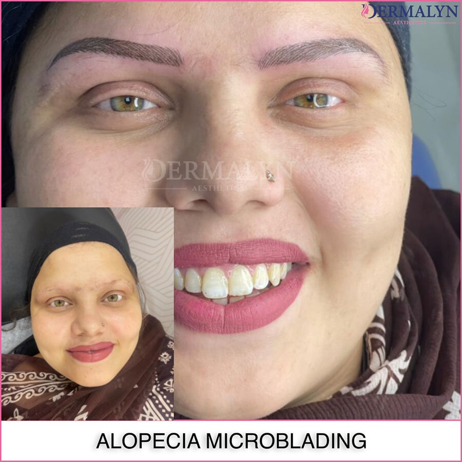 Alopecia Microblading in Delhi