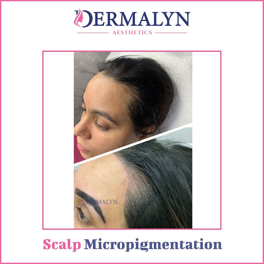 Scalp Micropigmentation in Delhi