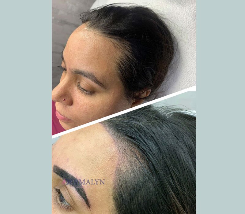 Scalp Micropigmentation in Delhi