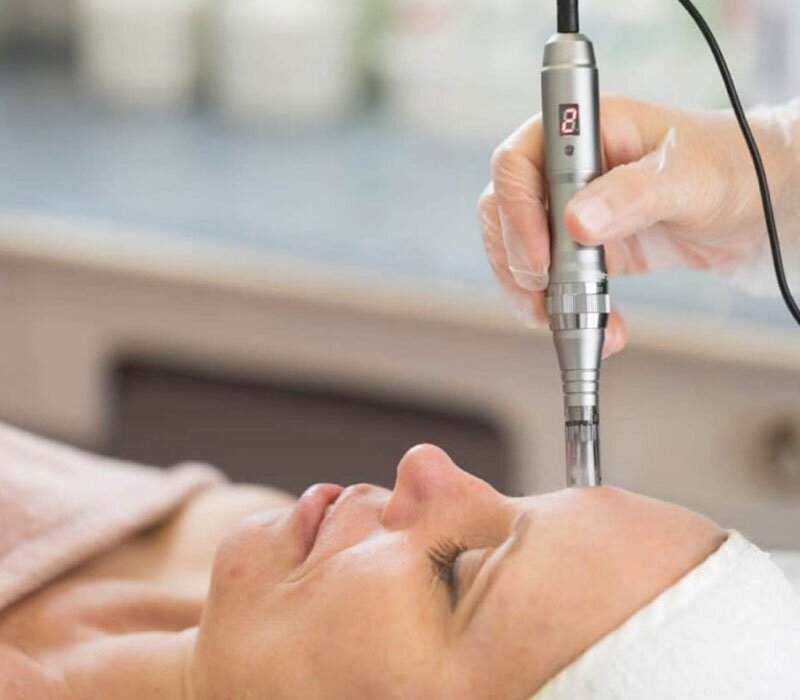 Collagen Induction Therapy in Delhi