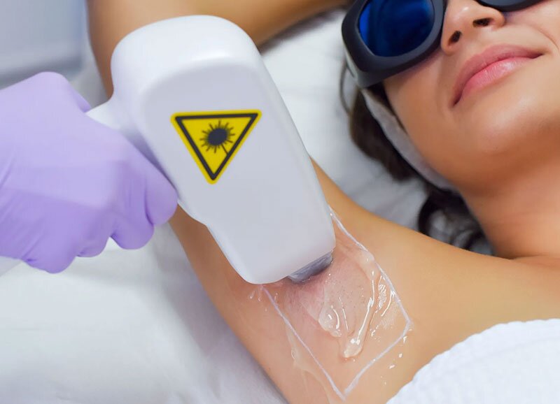 Laser Hair Removal Treatment in Delhi