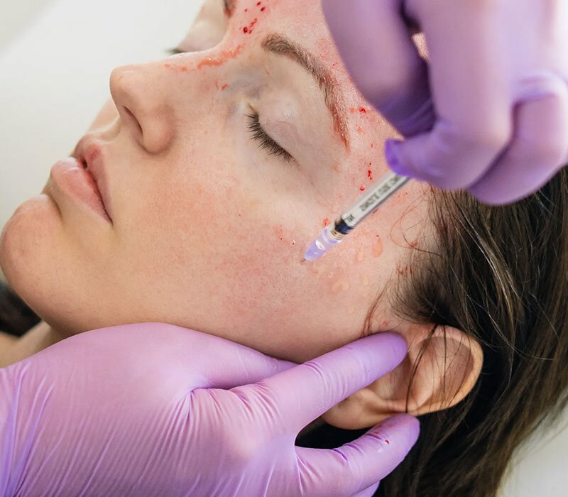 Vampire Facial in Delhi