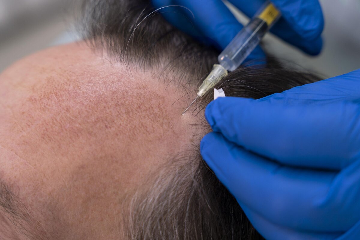 Scalp Micropigmentation In Delhi