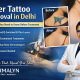 Laser Tattoo Removal in Delhi