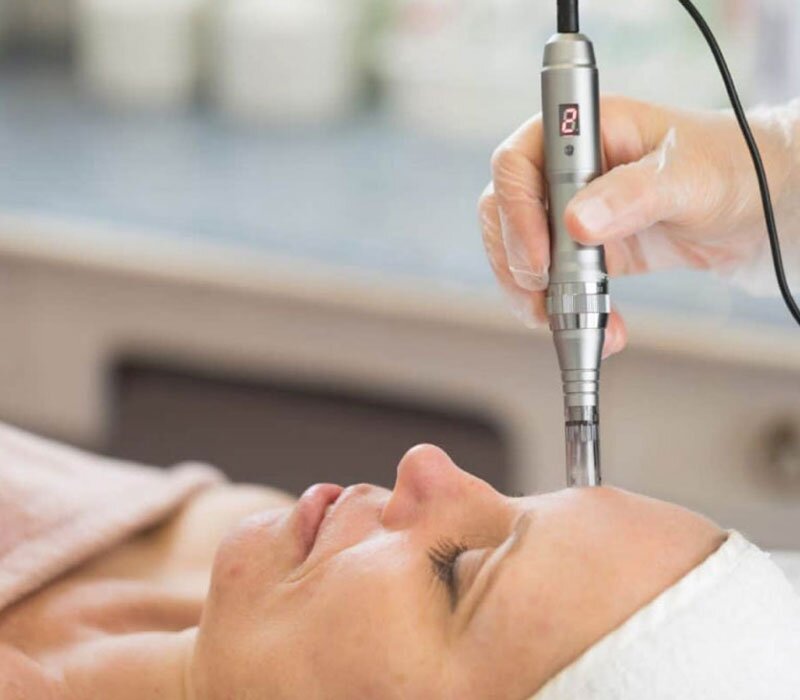 Collagen Induction Therapy